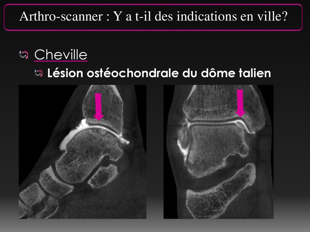 Arthro scanner Y a t il des indications en ville ppt t l charger